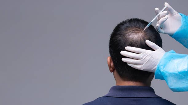 How Much Does Hair Transplant Cost for International Patients?
