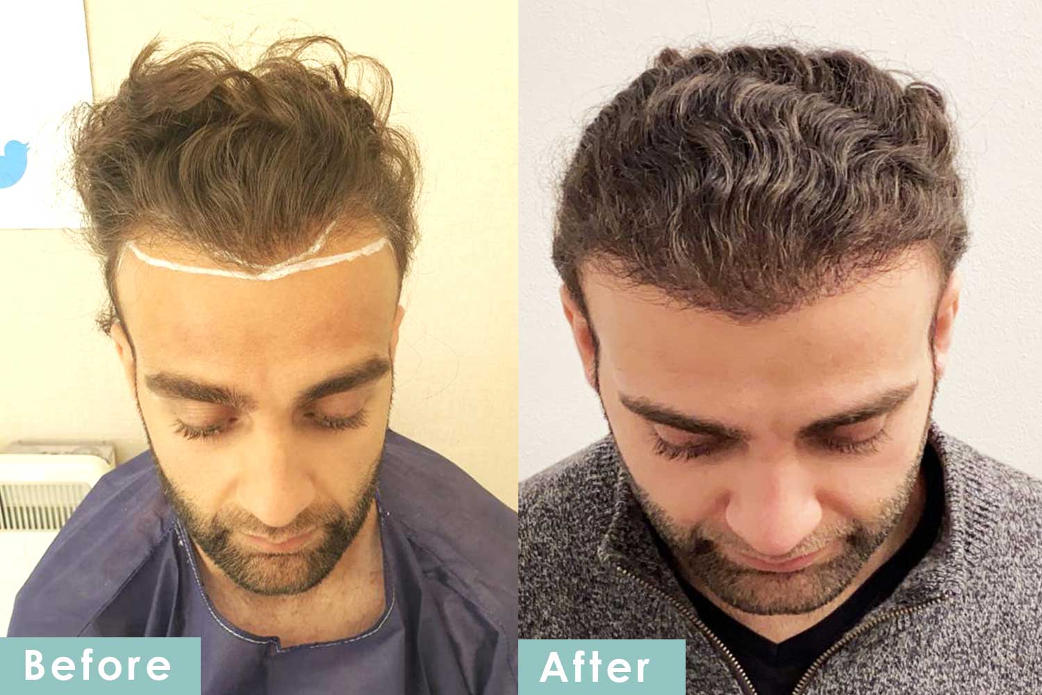 Hair Transplant London Reviews: Why Patients Trust Westminster Medical Group®